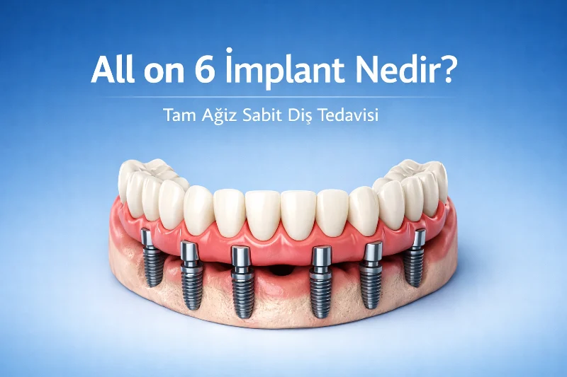 All-on-6 implants Istanbul