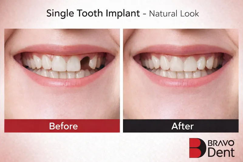 Tek diş implantı öncesi ve sonrası
