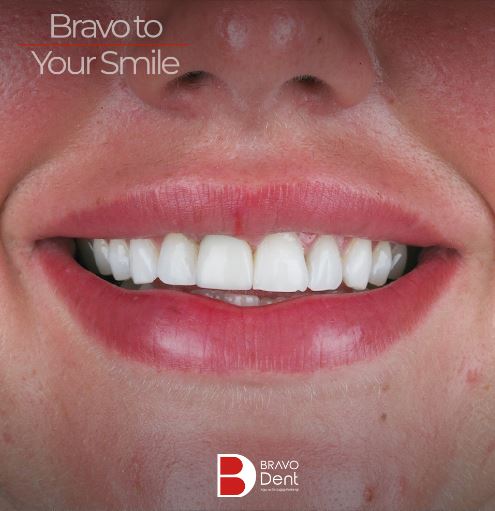 Turkey Teeth Before and After Pictures in Istanbul