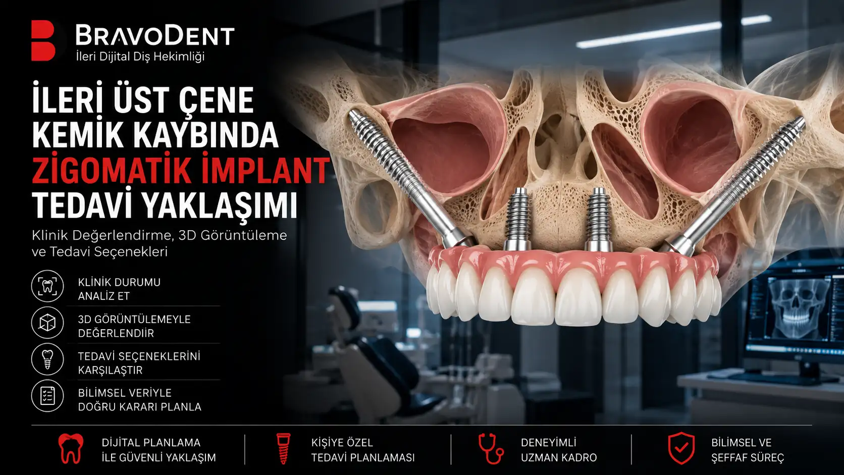 Üst çenede iki standart ve iki zigomatik implant ile tam ark protezi gösteren illüstrasyon