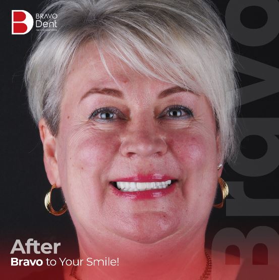 What are the pros and cons of dental implants? in Istanbul, Turkey Dental Clinic