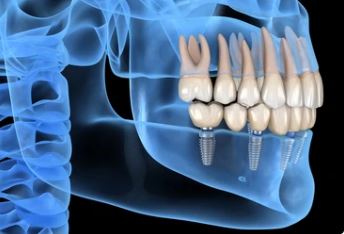 How long do dental implants treatments take? in Istanbul Turkey Dental Clinic