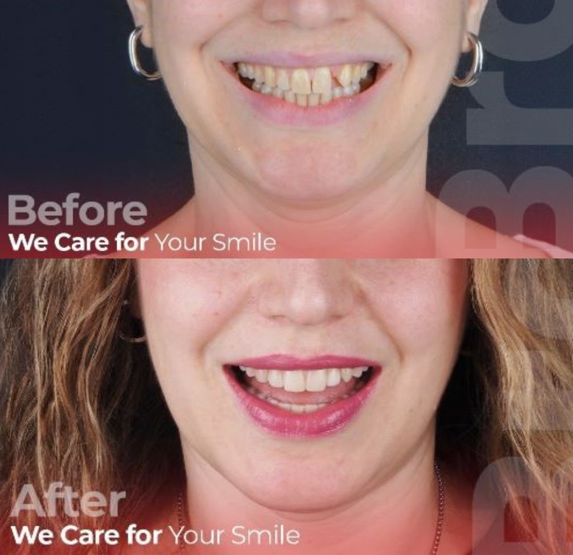 How long does dental implant treatment take? & How long do dental implants last? in Turkey, Istanbul