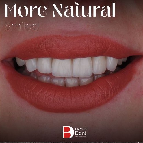E-max Veneers Pros and Cons & What is E-max used for? in Turkey, Istanbul