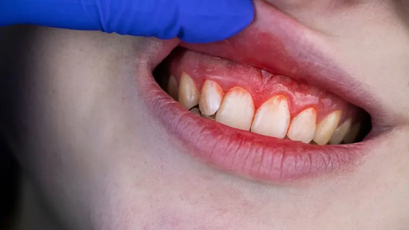 Diş Eti Hastalıkları: Belirtileri, Nedenleri ve Tedavi Yöntemleri - Bravodent Diş Kliniği İstanbul