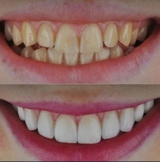 What can I do to improve my smile? and Ways to improve your smile in Turkey, Istanbul