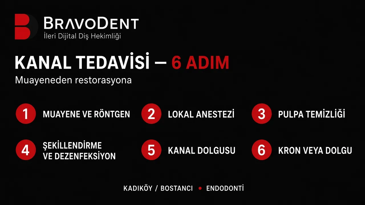 Kanal tedavisi 6 adım: muayene, anestezi, pulpa temizliği, dezenfeksiyon, kanal dolgusu ve kron. Bravodent Kadıköy endodonti