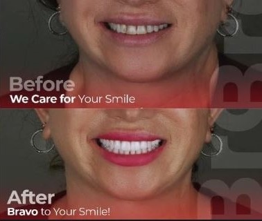 How much are laminate veneers in Turkey? & How long do veneers last in Turkey?