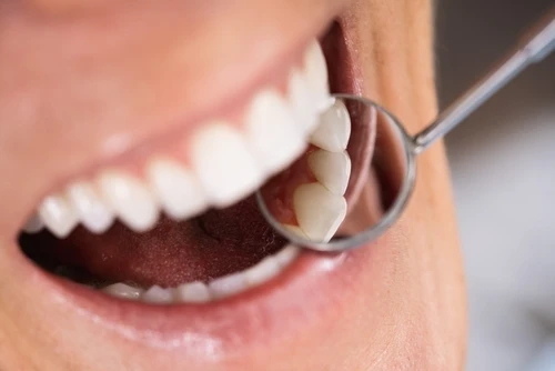 Exposure of impacted canines